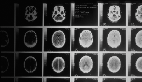 Study shows coronavirus can have long-term effects on the brain