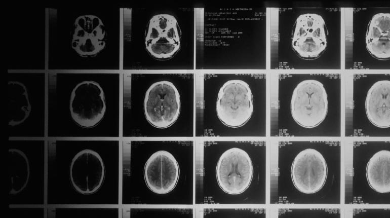 Study shows coronavirus can have long-term effects on the brain